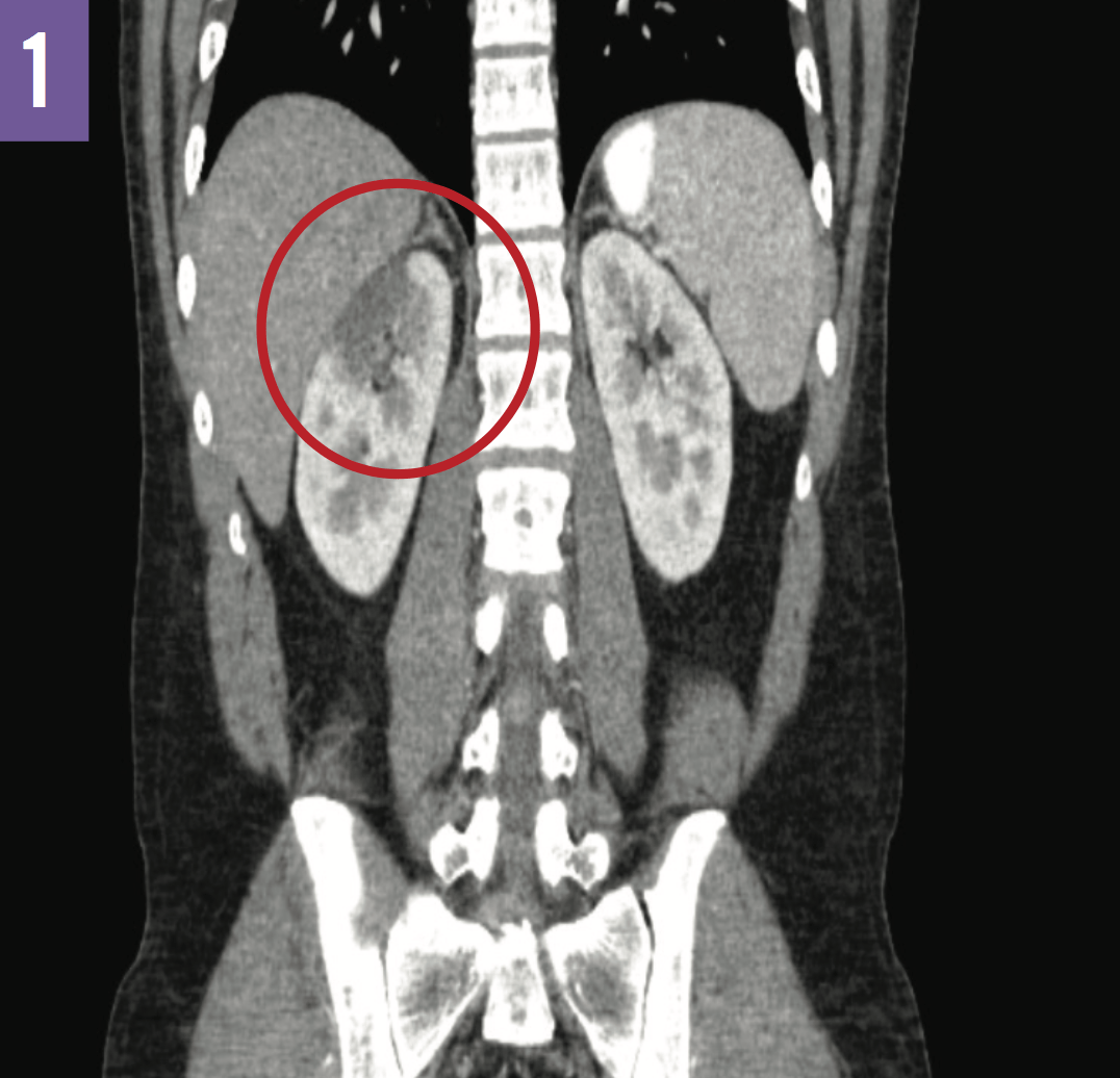 Renal Infarction in EhlersDanlos Syndrome Consultant360